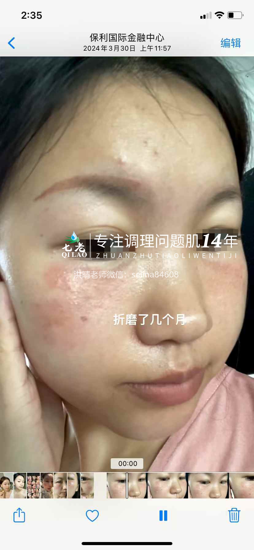 七老突发过敏修护案例