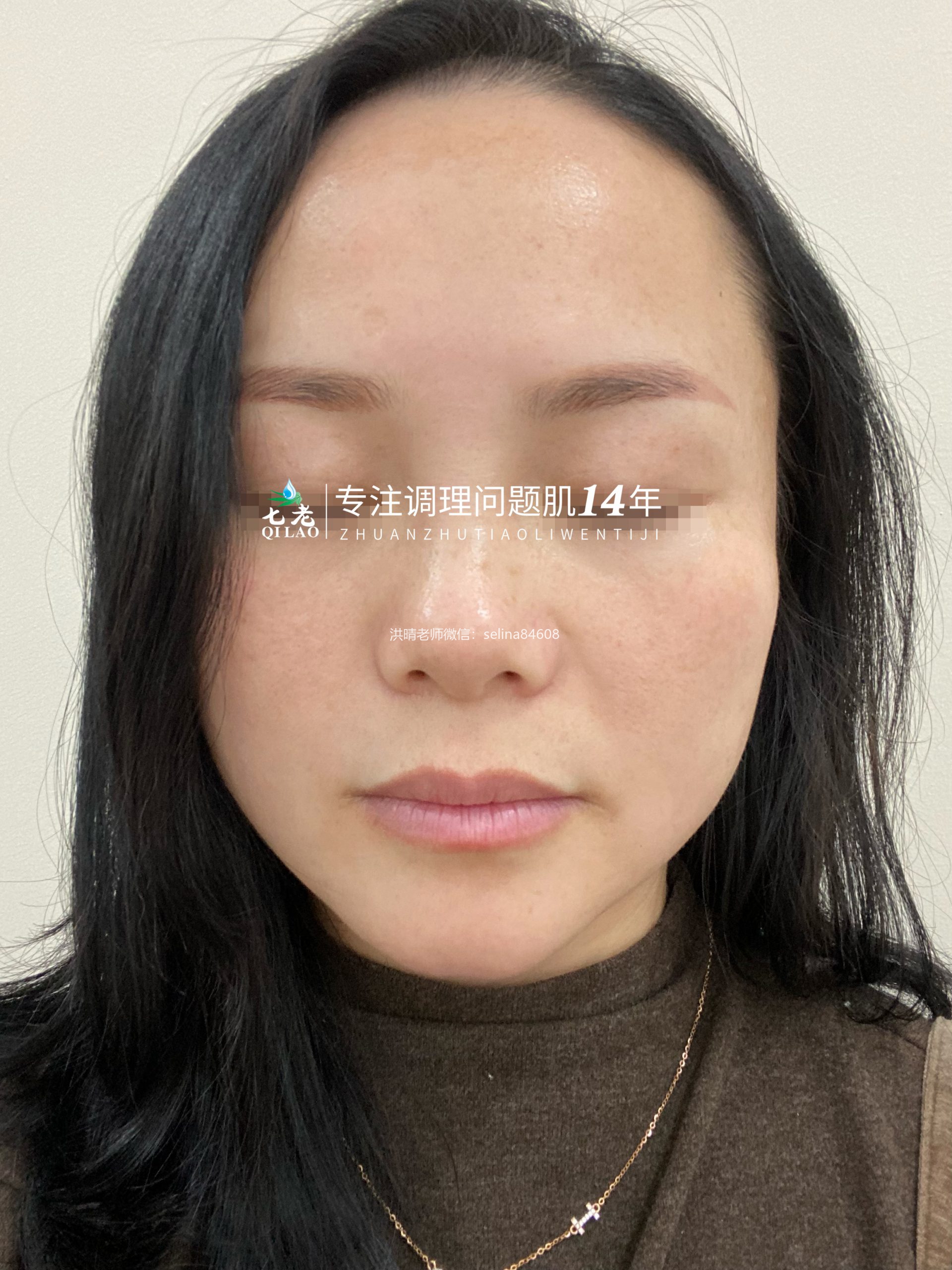 七老激素脸修护案例