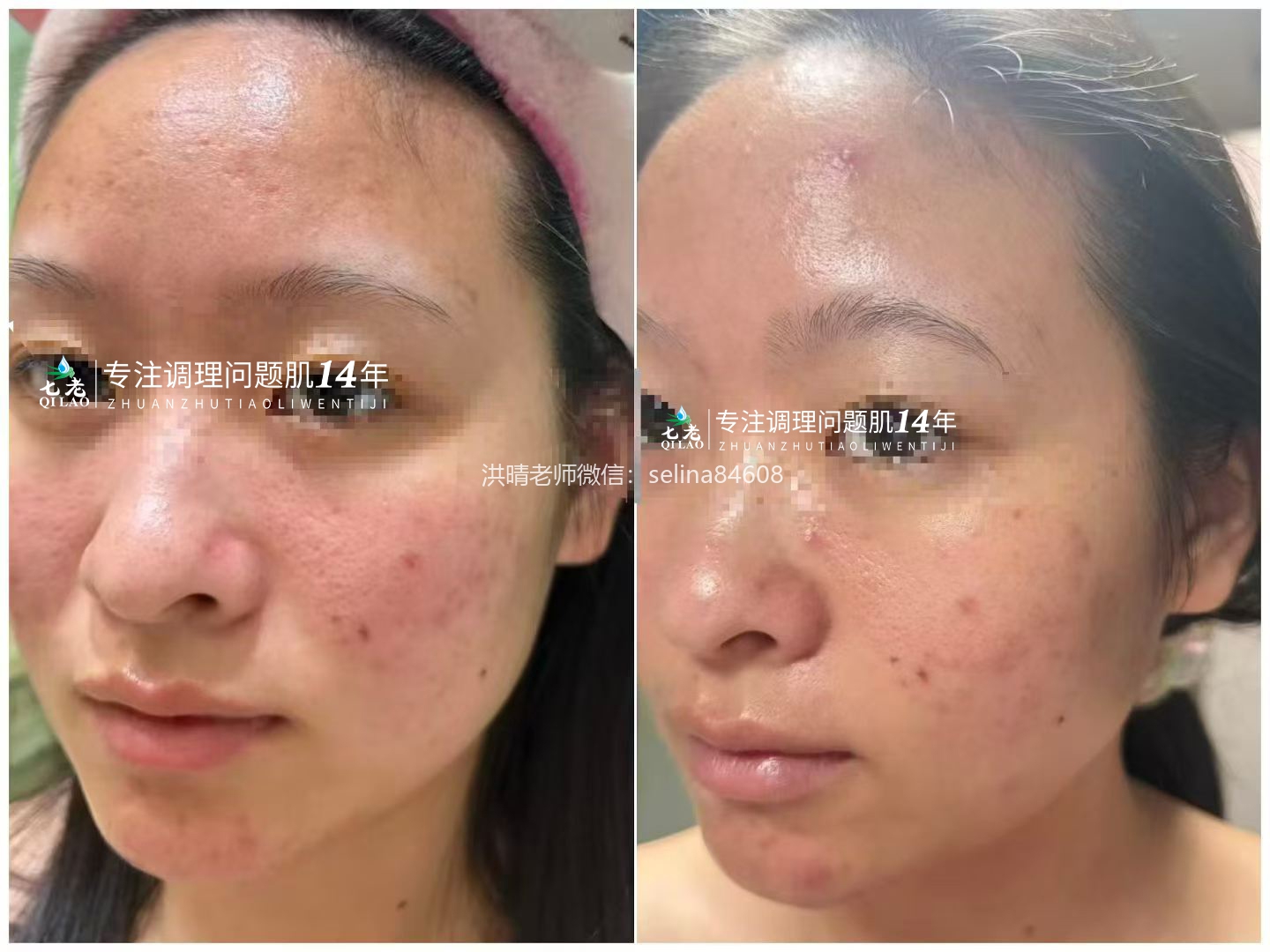 七老油敏痘痘痘肌修护案例