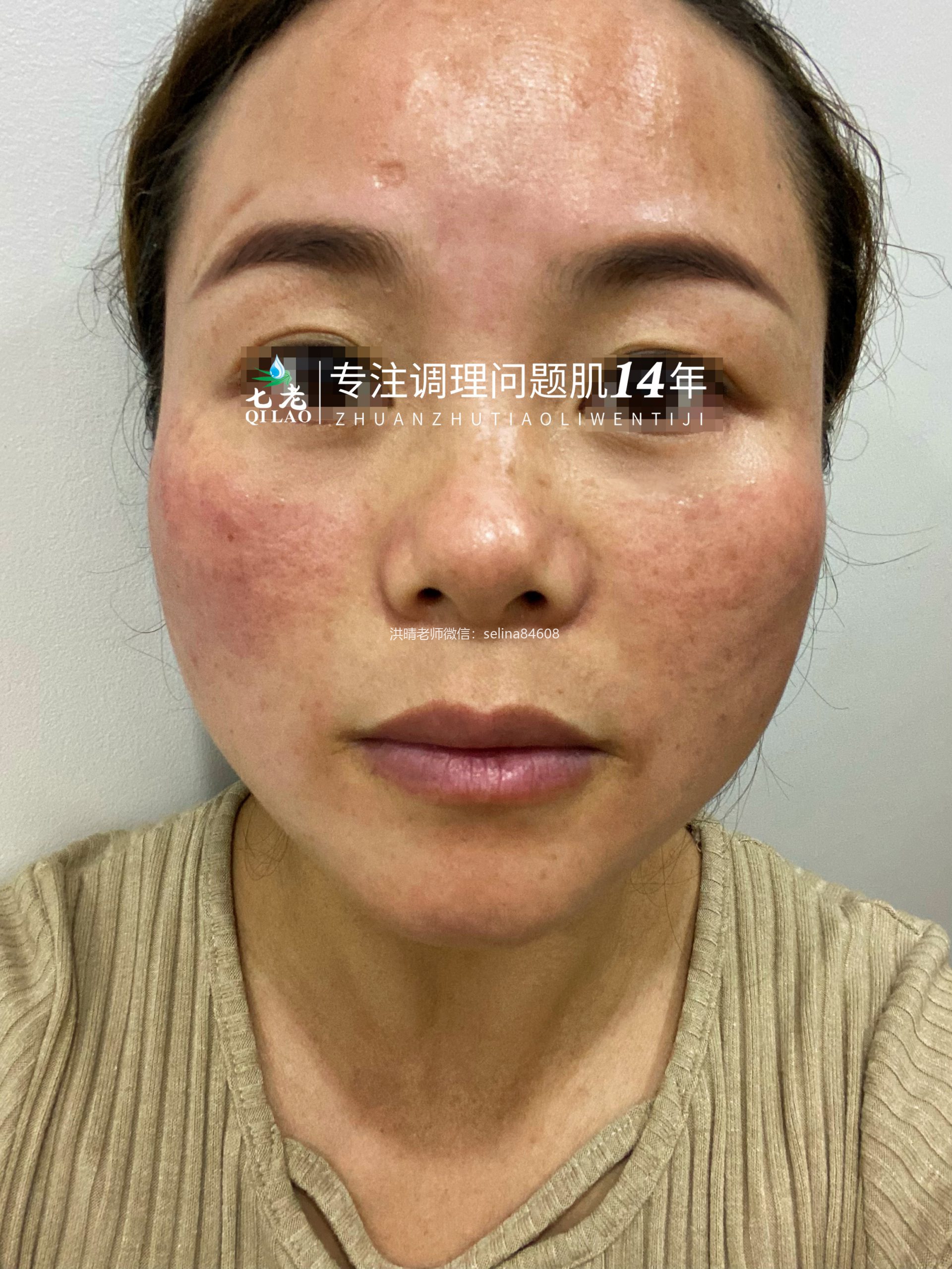 七老激素脸修护案例