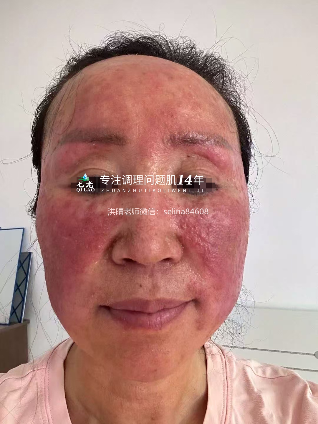 七老严重激素脸玫瑰痤疮修护案例