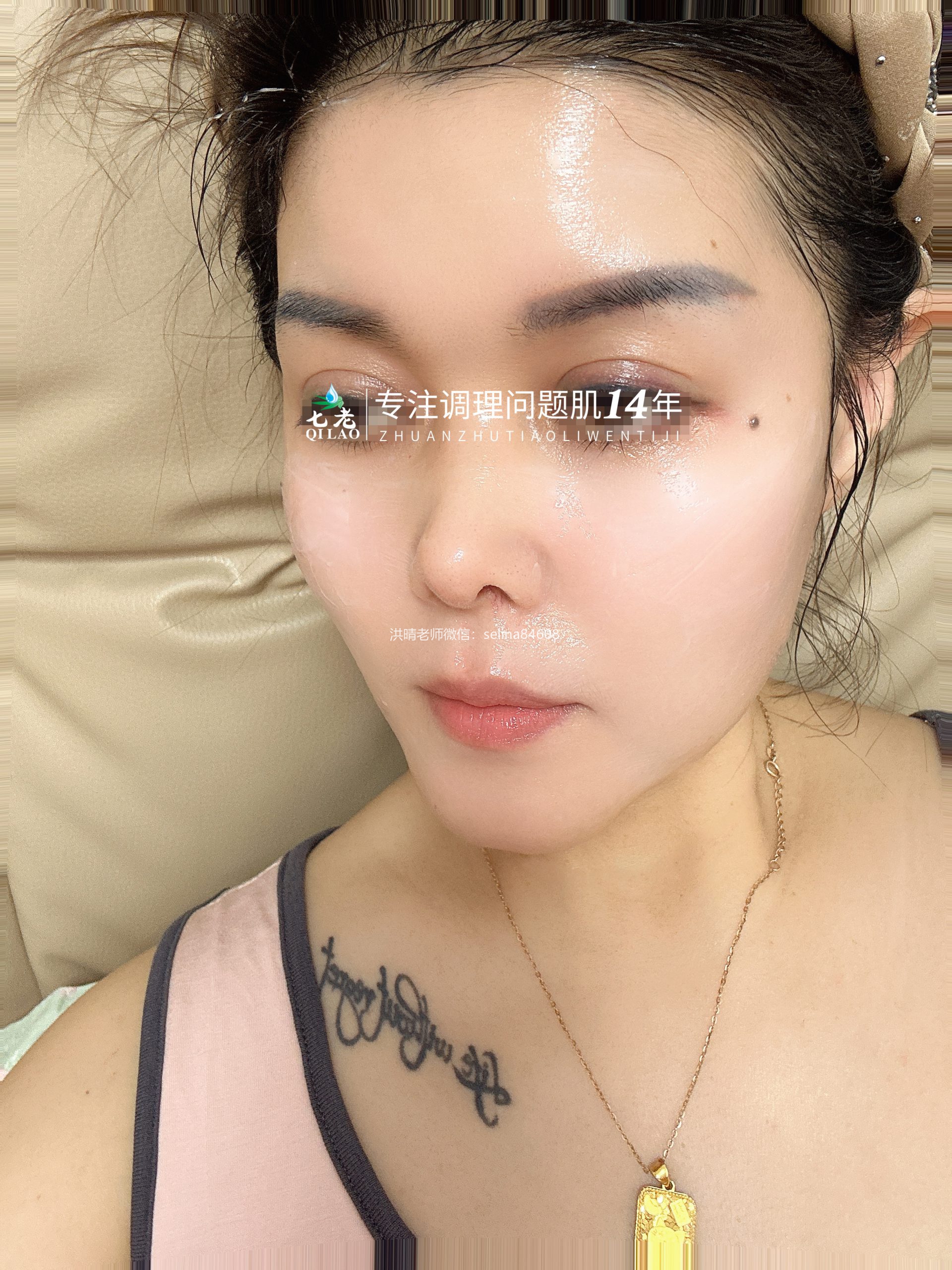七老激素脸红烫痒修护案例