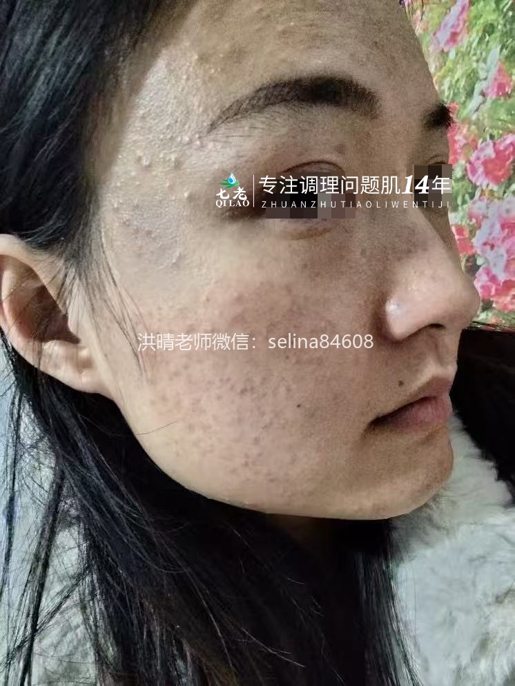 七老脂皮痘痘修护案例