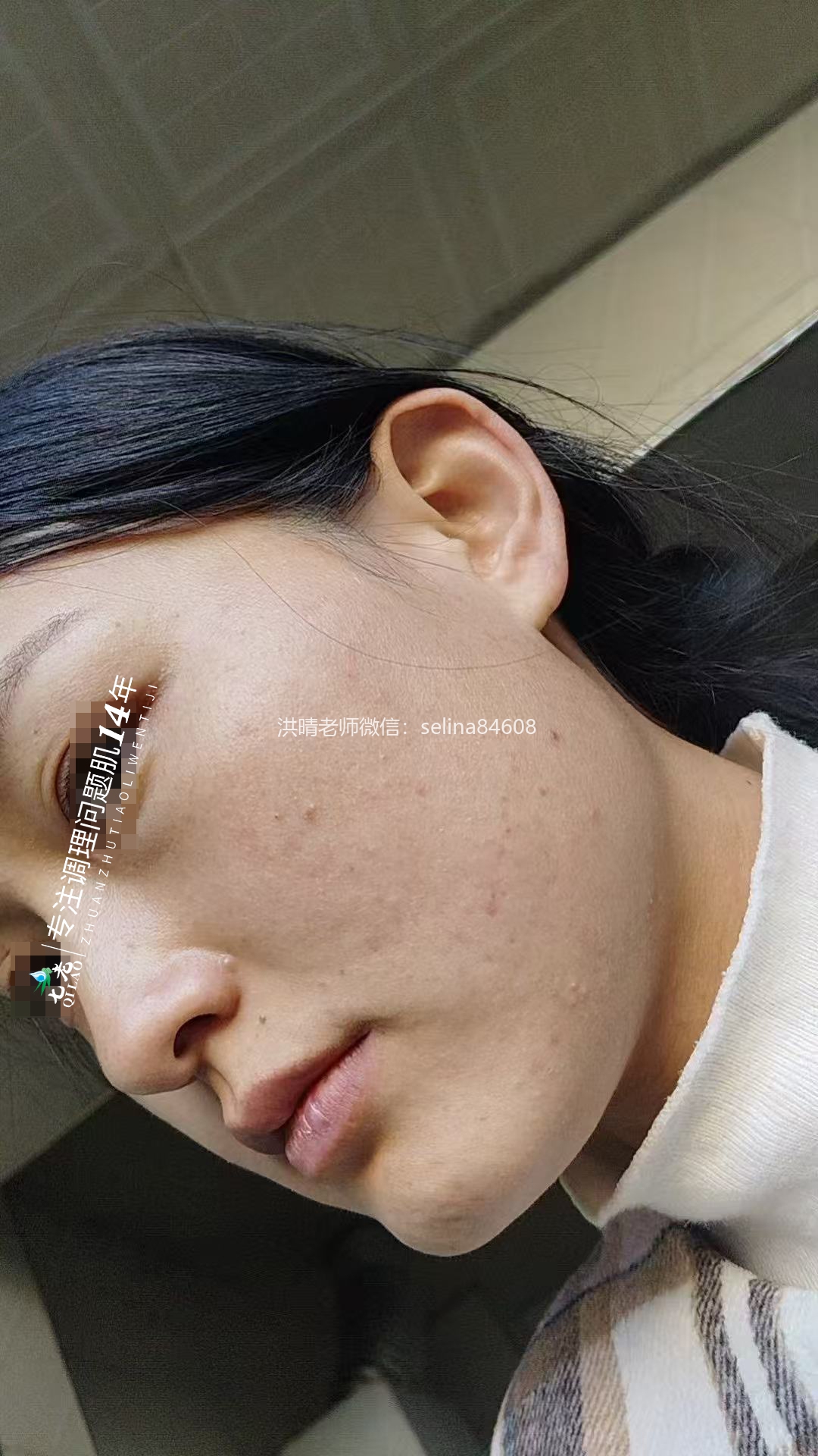 七老脂皮痘痘修护案例