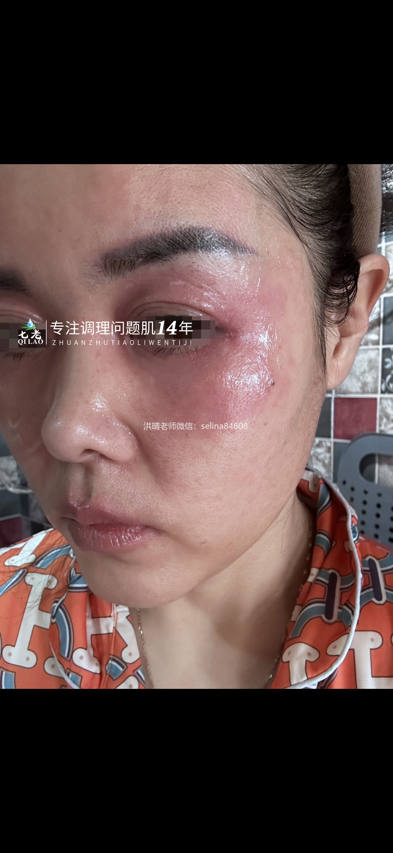 七老激素脸红烫痒修护案例