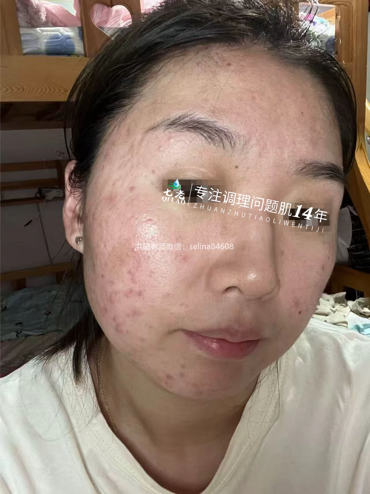 七老新品净孔祛痘系列内测反馈
