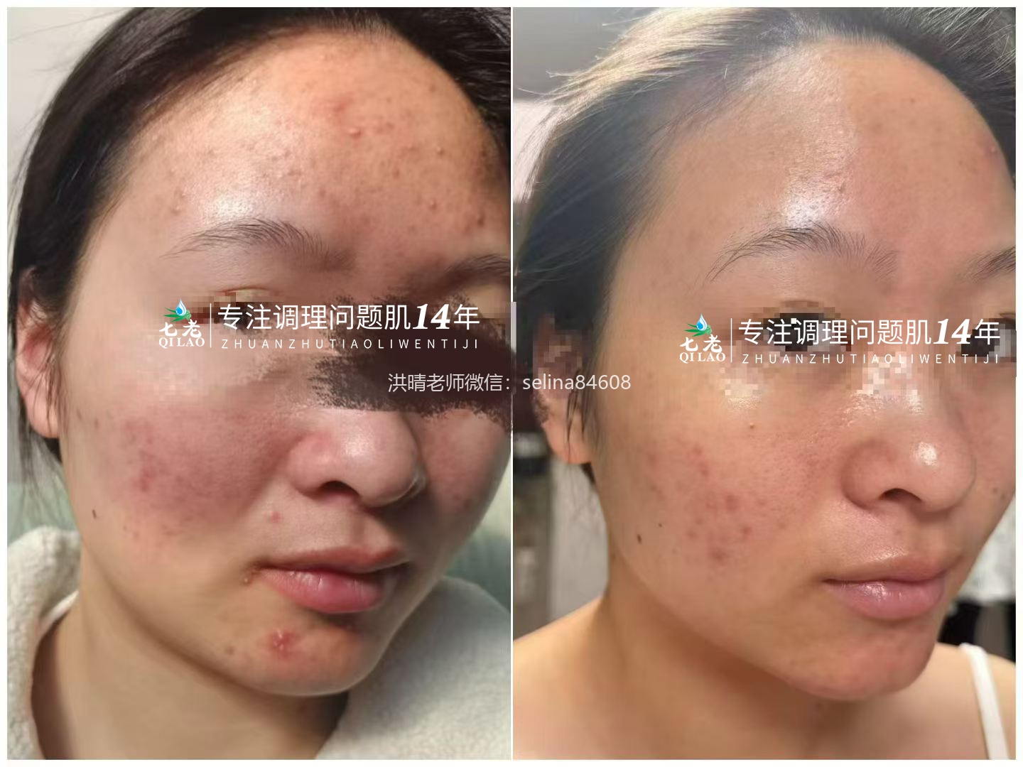七老油敏痘痘痘肌修护案例