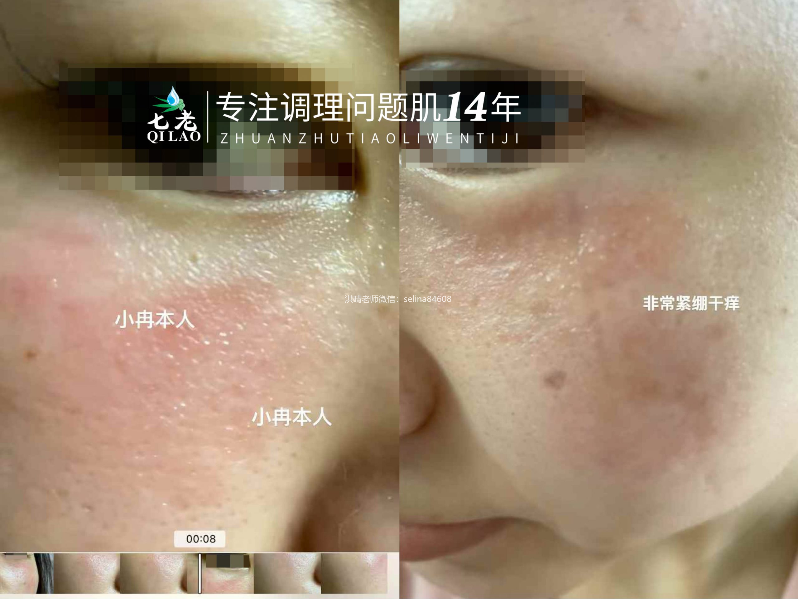 七老突发过敏修护案例