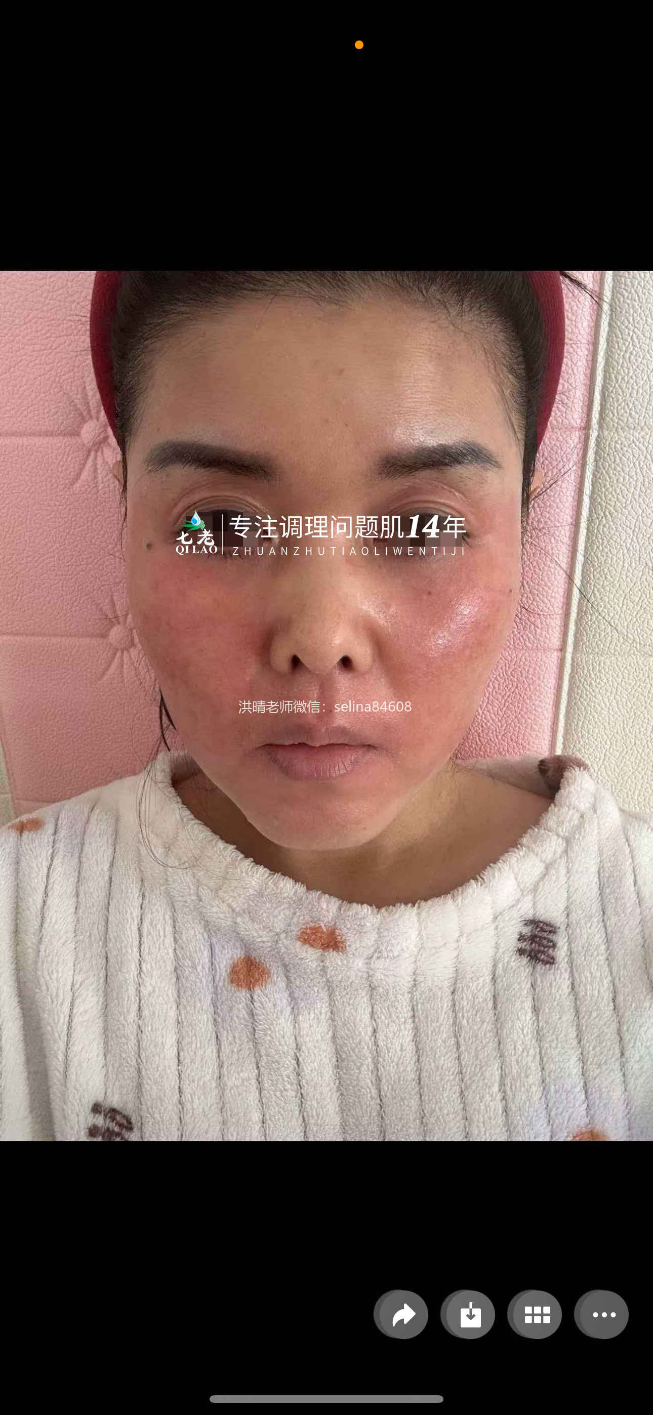 七老激素脸红烫痒修护案例