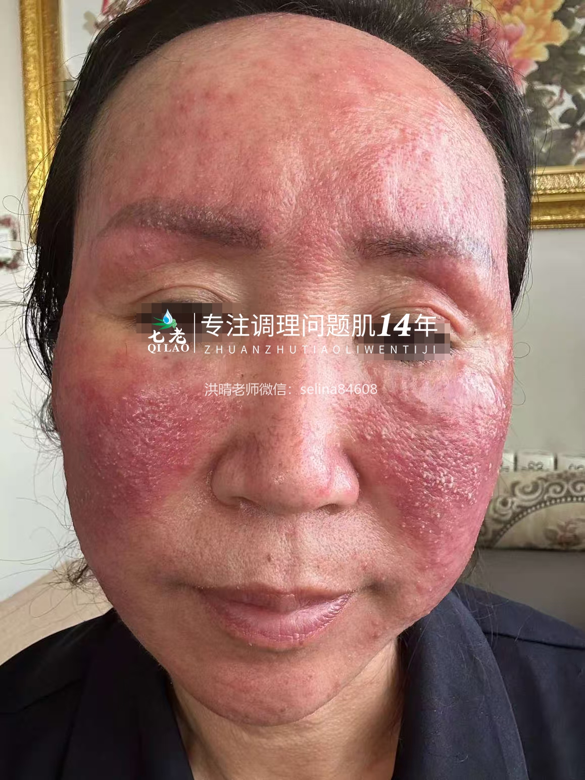 七老严重激素脸玫瑰痤疮修护案例