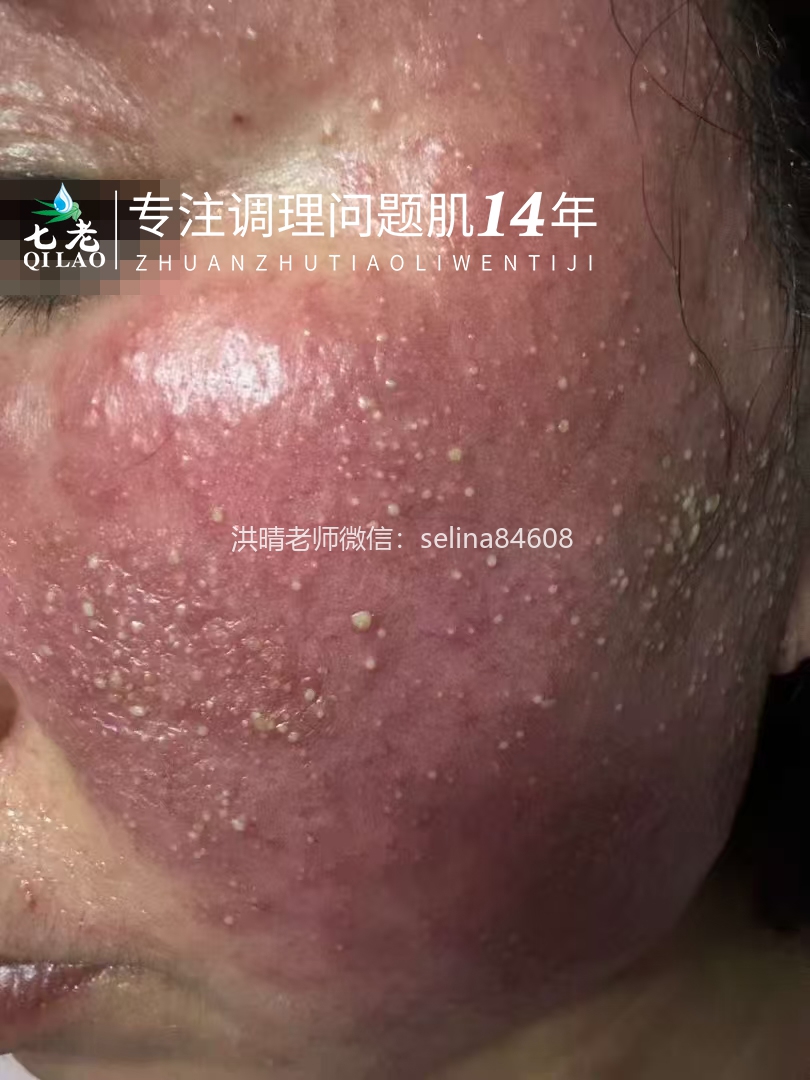 七老严重激素脸玫瑰痤疮修护案例