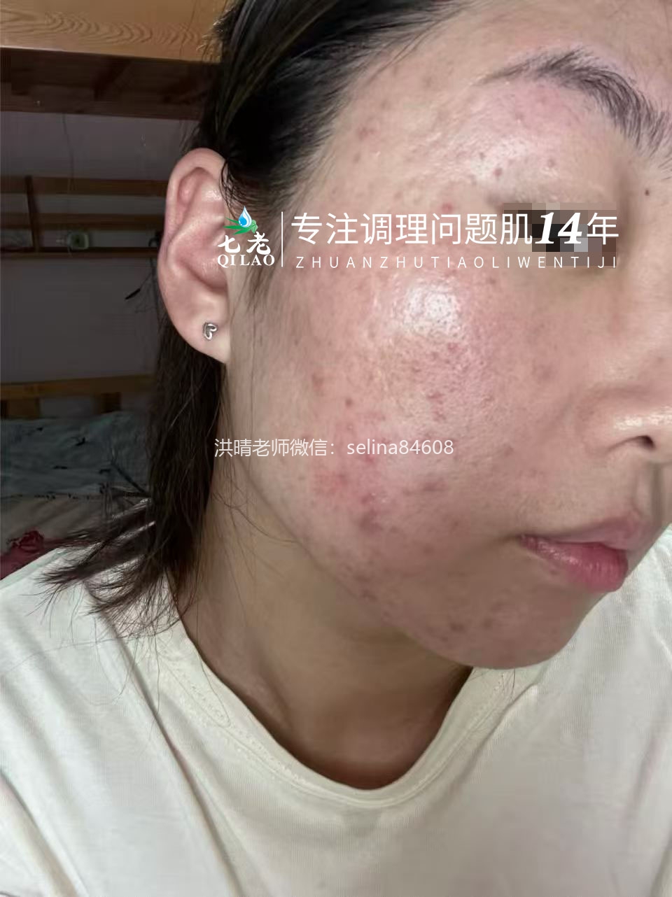 七老新品净孔祛痘系列内测反馈