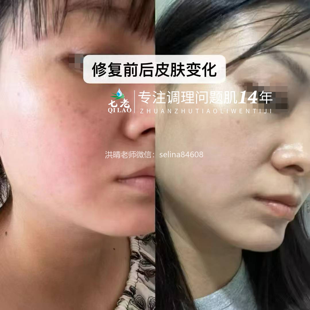 七老大红脸修护案例