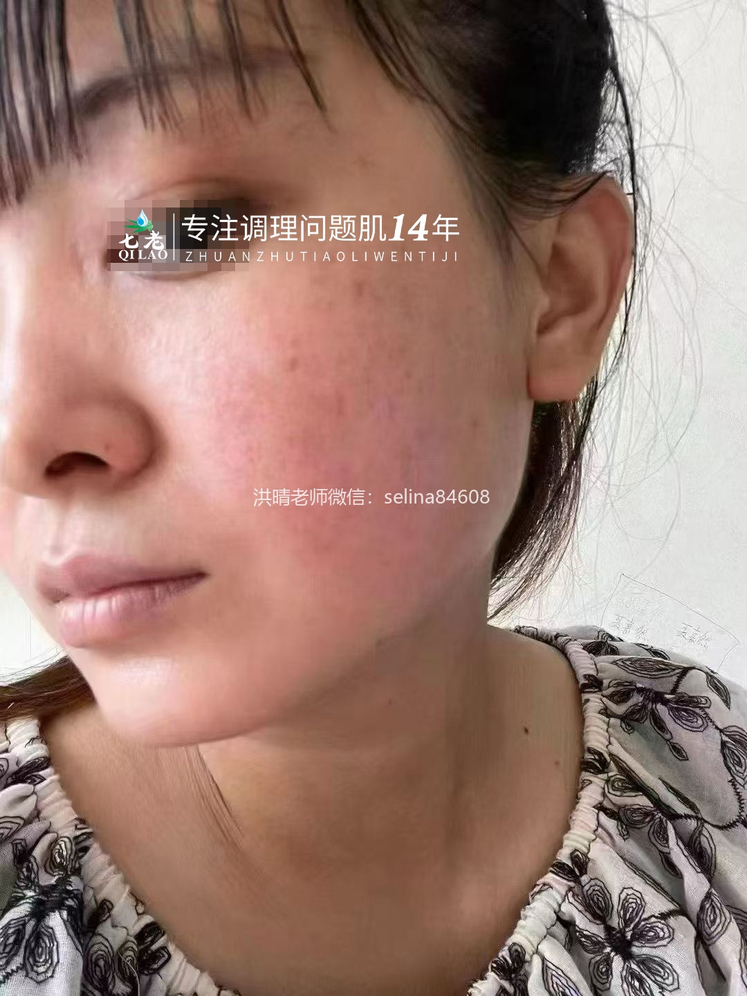 七老大红脸修护案例