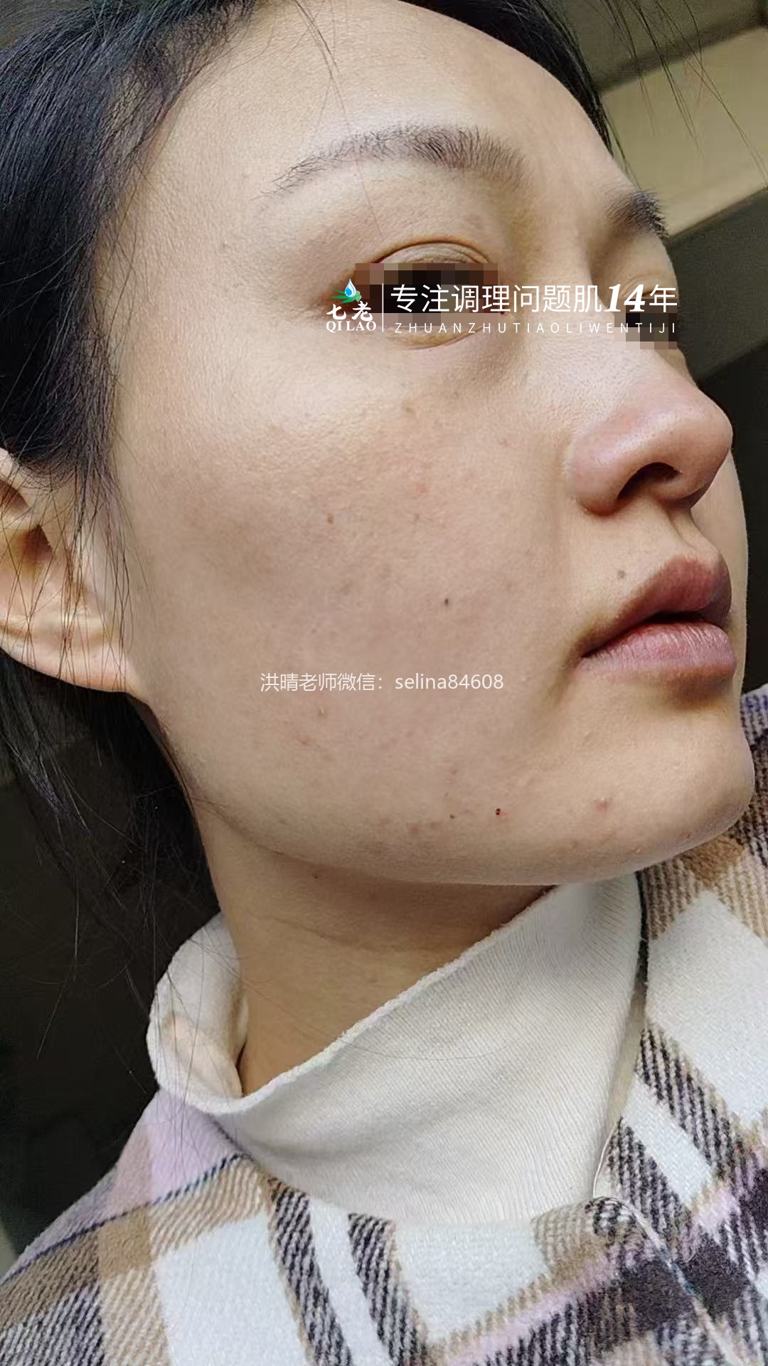 七老脂皮痘痘修护案例
