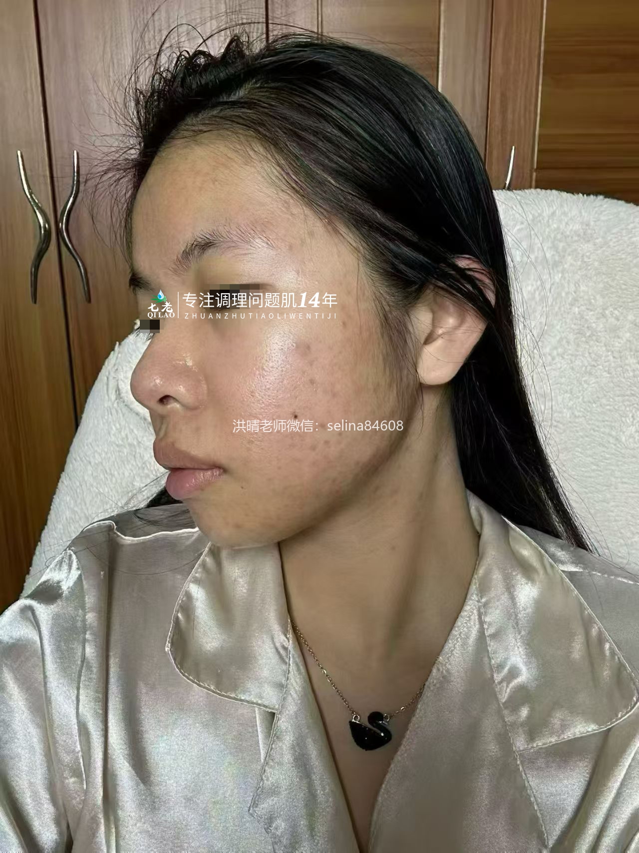 七老新品金线莲内测油敏疹子痘痘修护案例