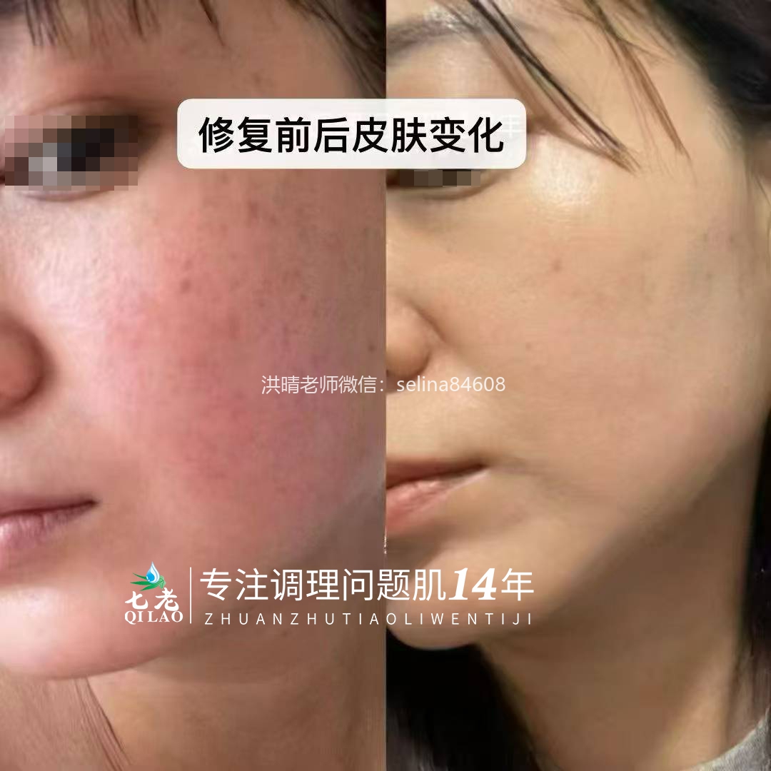 七老大红脸修护案例