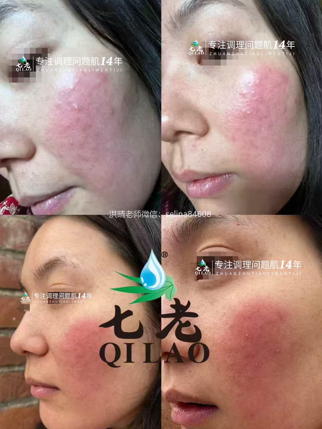 七老红烫痒疹子修护案例