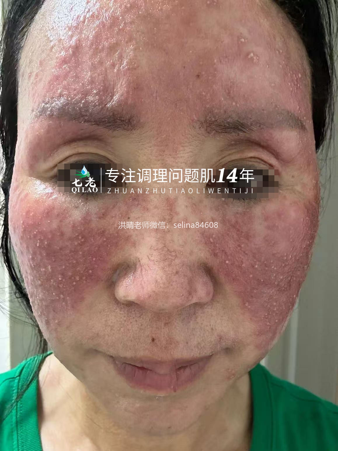七老严重激素脸玫瑰痤疮修护案例