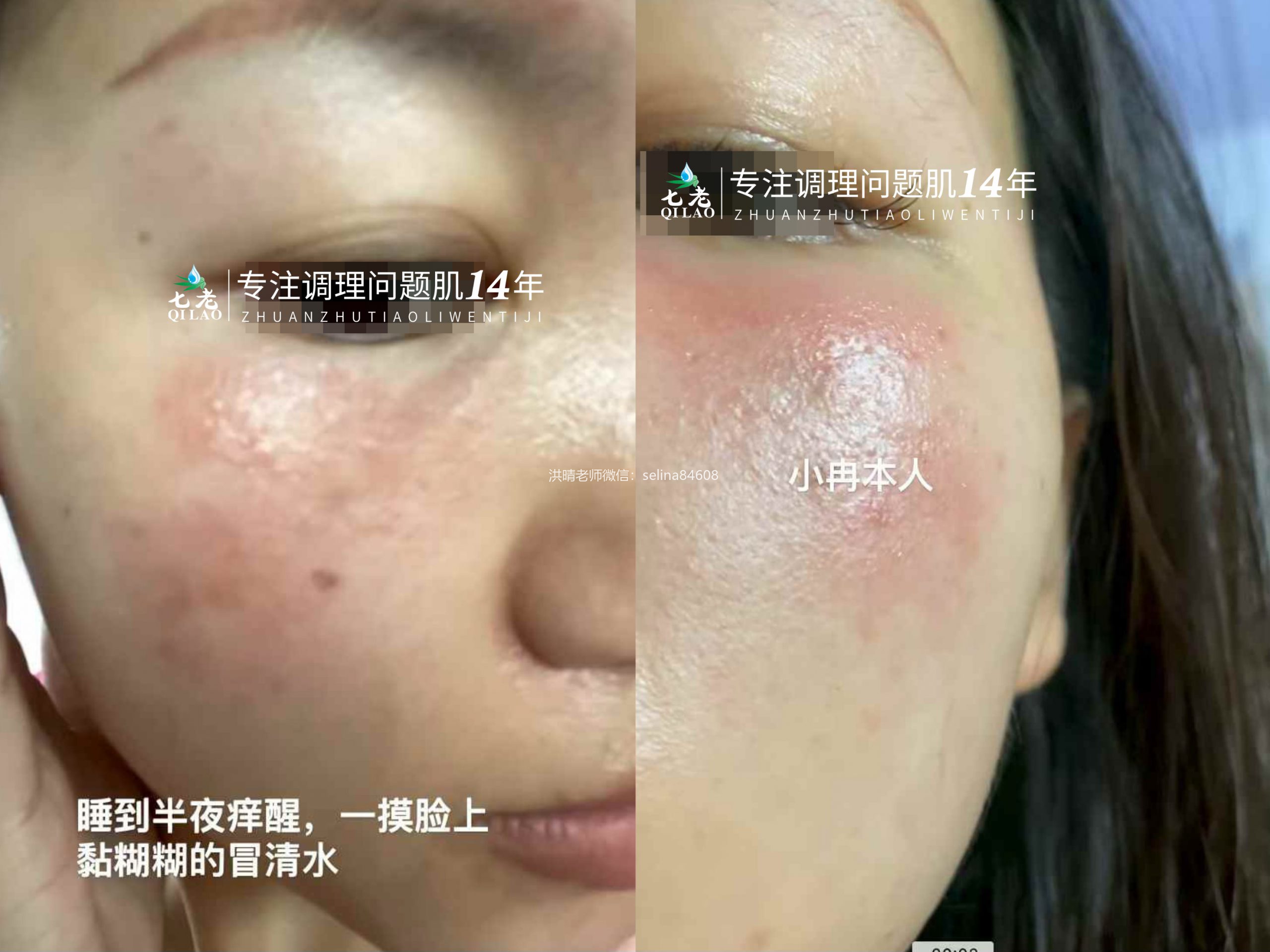 七老突发过敏修护案例