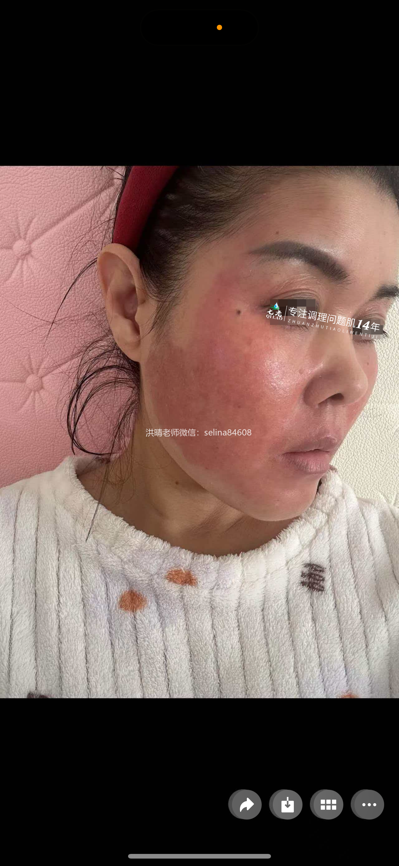 七老激素脸红烫痒修护案例