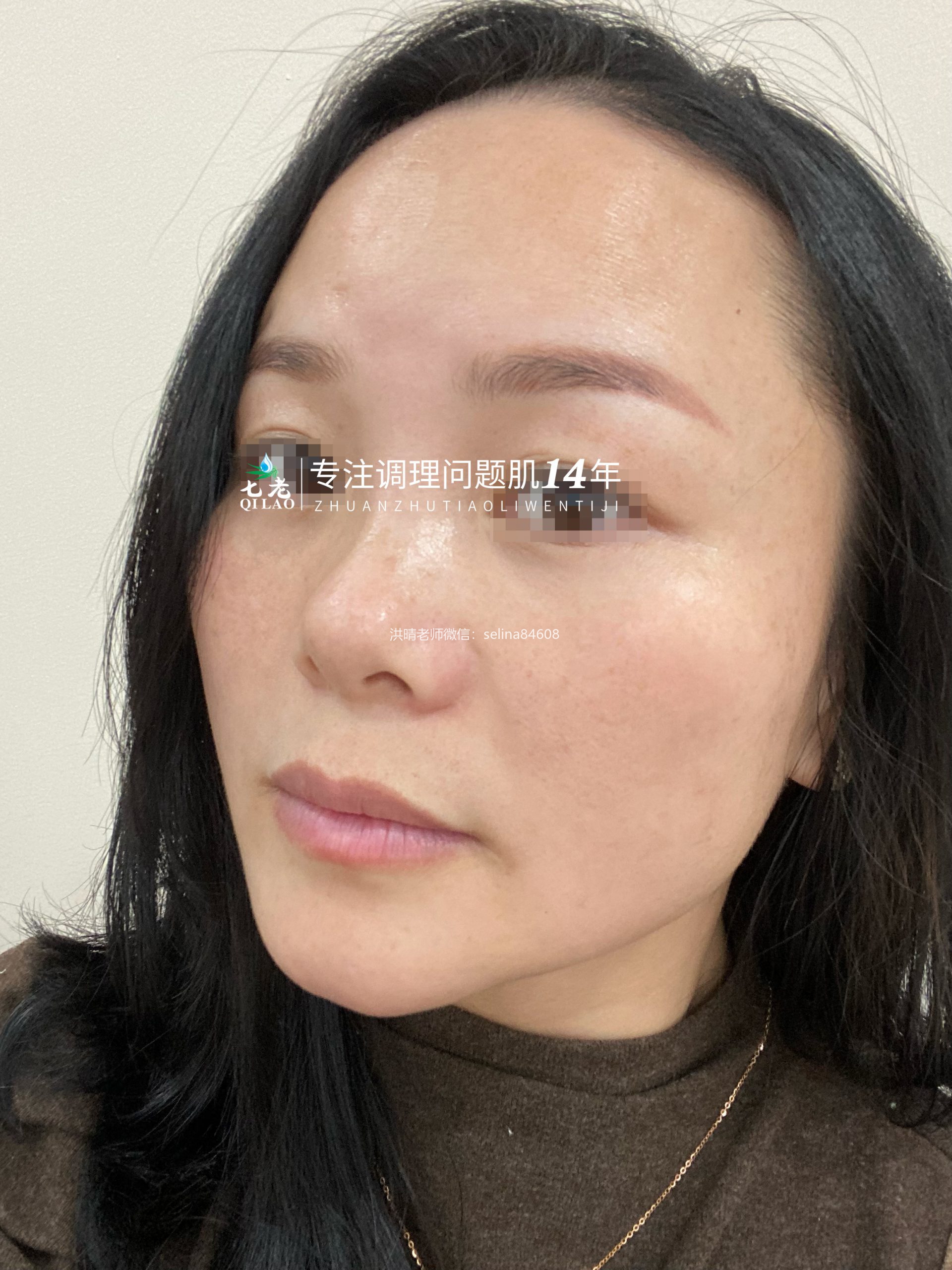 七老激素脸修护案例