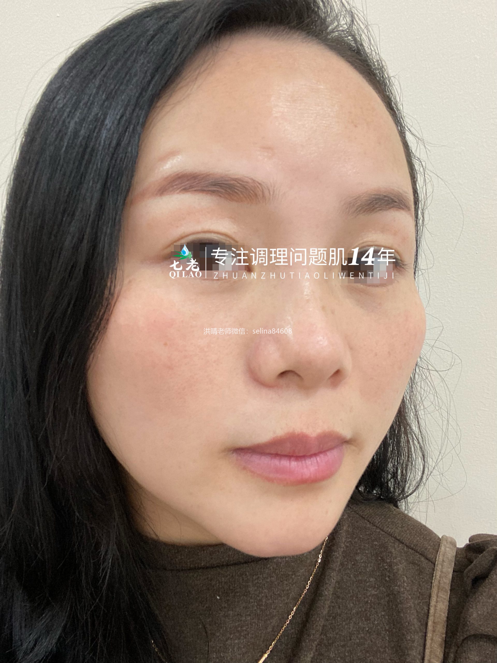 七老激素脸修护案例