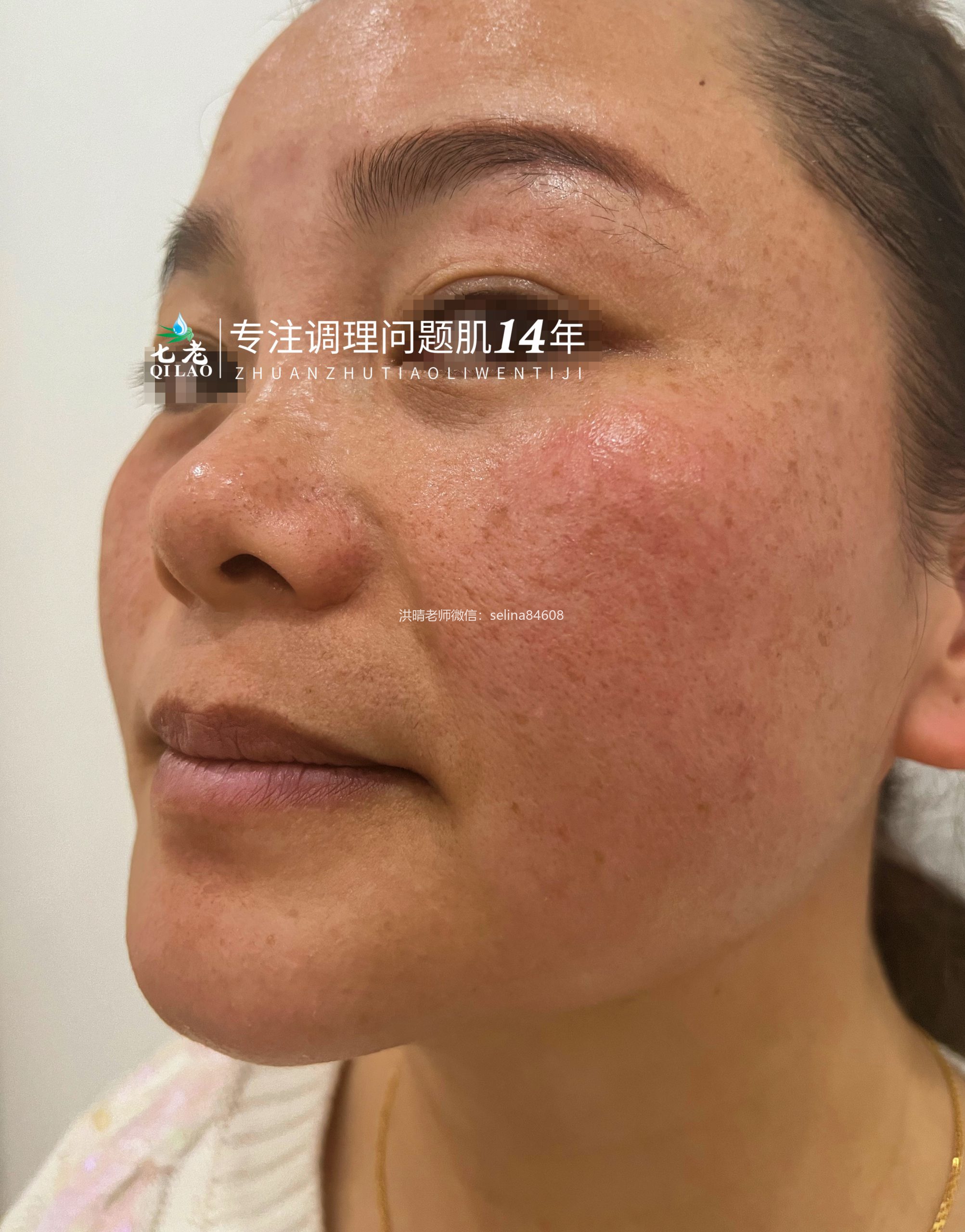 七老激素脸修护案例