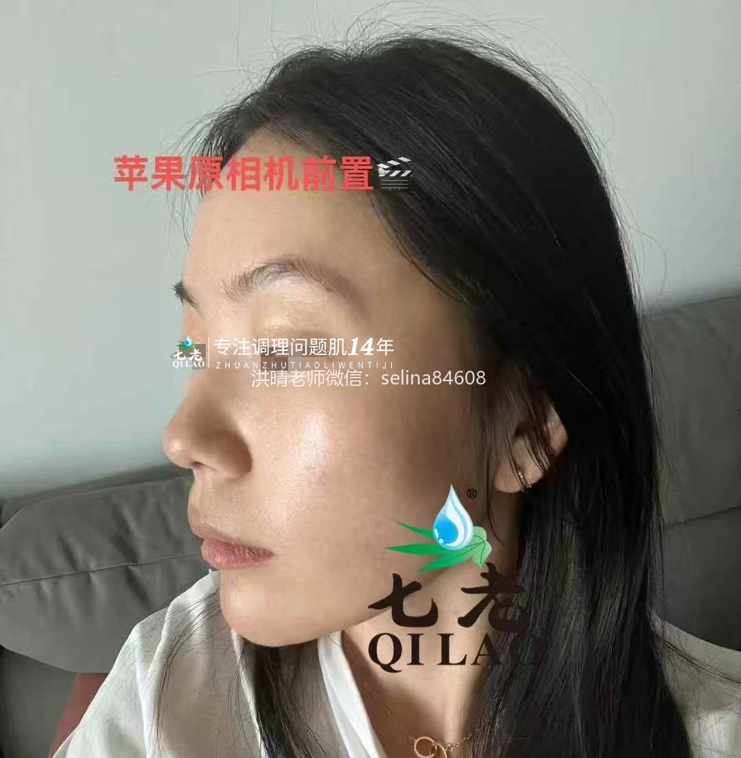 七老红烫痒疹子修护案例