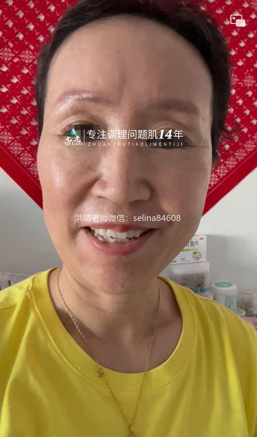 七老严重激素脸玫瑰痤疮修护案例